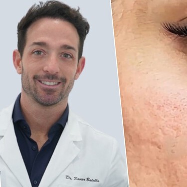 Xavier Batalla, médico: "Si notas que cada año los poros se ven más grandes, no es solo por grasa o suciedad, es porque tu piel va perdiendo colágeno con el paso del tiempo"