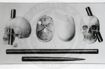Phineas Gage y el cambio de personalidad