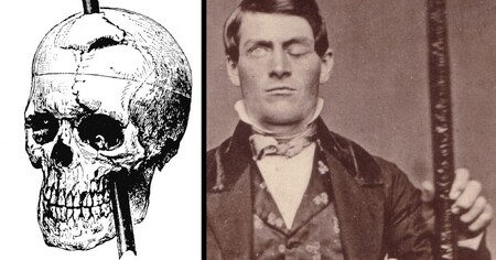 Este es el objeto más grande extraído de un cráneo humano
