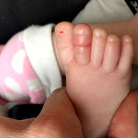 Síndrome del torniquete en los bebés: ojo con los hilos y los pelos