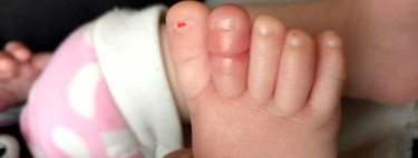 Síndrome del torniquete en los bebés: ojo con los hilos y los pelos