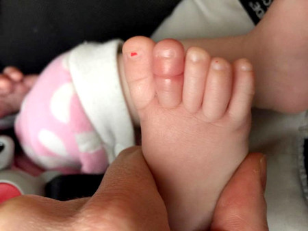 Síndrome del torniquete en los bebés: ojo con los hilos y los pelos
