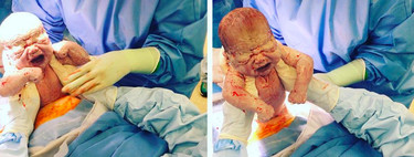 Las increíbles fotos de una cesárea en las que la madre saca a su cuarto bebé con sus propias manos