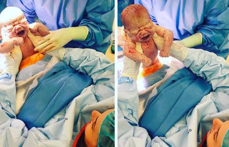 Las increíbles fotos de una cesárea en las que la madre saca a su cuarto bebé con sus propias manos
