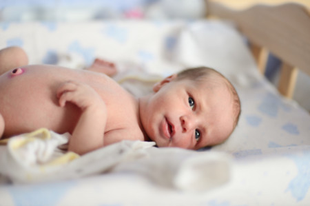 hernia-umbilical