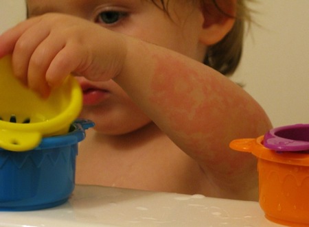 Dermatitis atópica: definición, causas, síntomas y tratamiento