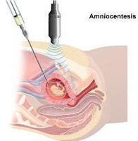 Pruebas prenatales invasivas antes de los 35 años, la mamá elige