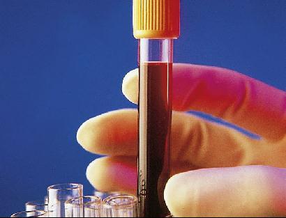Análisis de sangre para detectar el síndrome de Down sin riesgos