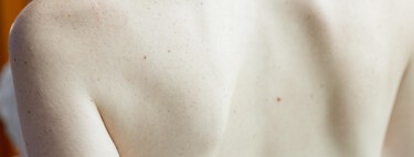 Todo sobre la psoriasis: qué es, por qué se produce, cómo se trata y cómo puedes ayudar a su normalización