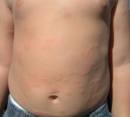 Niño con urticaria