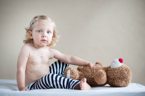 La vacuna de la varicela se administrará en el 2016, pero la OCU se posiciona en contra: ¿qué hacer?