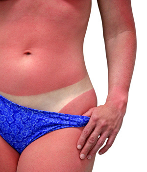 Qué hacer si nos quemamos tomando el sol