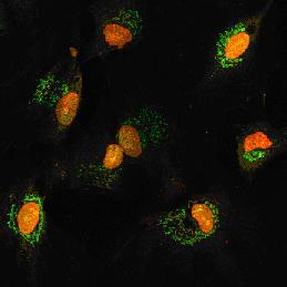 Una toxina "ilumina" las células cancerígenas