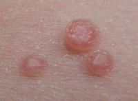 Moluscos contagiosos en la piel de los niños