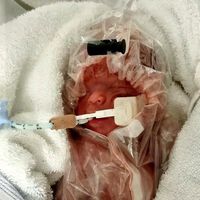 Un bebé que nació con 600 gramos y logró sobrevivir gracias a una bolsa de plástico se va a casa tras cuatro meses en la UCI