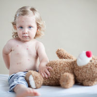 Los casos de sarampión en 2018 baten récords en Europa