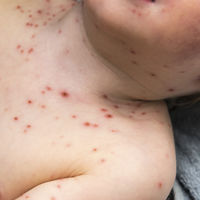 España consigue la acreditación de país libre de sarampión 