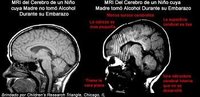 El alcohol reduce el tamaño del cerebro del bebé y puede producir la muerte fetal 