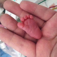 La bebé más pequeña de la historia: pesó 225 gramos al nacer y su pie era prácticamente como una uña 