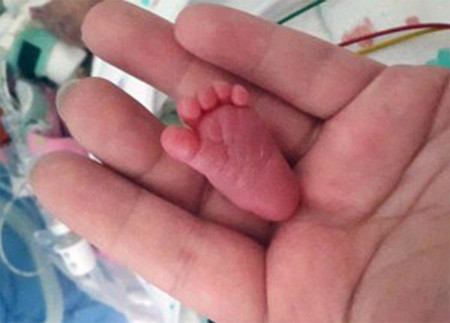 La bebé más pequeña de la historia: pesó 225 gramos al nacer y su pie era prácticamente como una uña