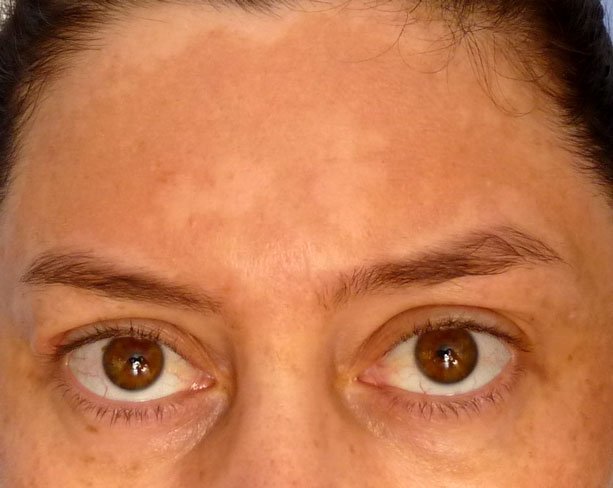 Estoy embarazada y tengo manchas oscuras en la piel: me ha salido un cloasma en el rostro