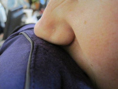 Rinorrea durante el ejercicio, una condición frecuente en corredores y nadadores