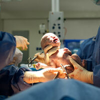 Las cesáreas continúan aumentando y lo seguirán haciendo, advierte la OMS: uno de cada cinco bebés nacen por cesárea 