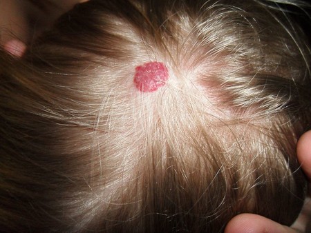 Qué es un angioma, por qué aparece y cómo se trata