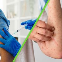 Sarampión ya tiene más de 3,500 contagios en México y se propaga más rápido que el COVID