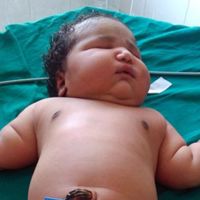 Nació la bebé más grande del mundo en la India con 6,8 kilos, el peso de un bebé de seis meses 