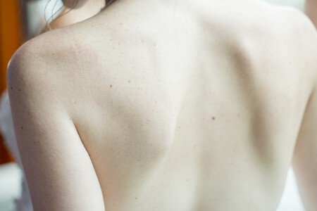 Todo sobre la psoriasis: qué es, por qué se produce, cómo se trata y cómo puedes ayudar a su normalización