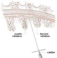 Escoliosis y epidural