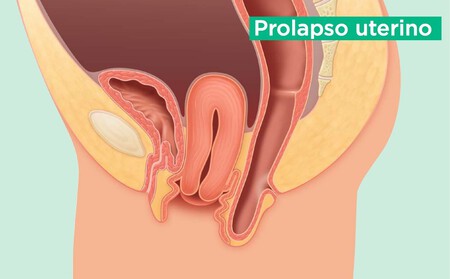 prolapso