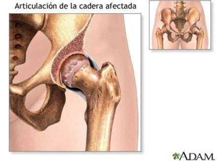 Osteomalacia: ¿qué es y cómo prevenirla?