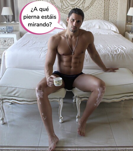 ¿Qué son las manchas que tiene Luca Onestini en las piernas? El concursante de 'Secret story' nos saca de dudas sobre su enfermedad en la piel