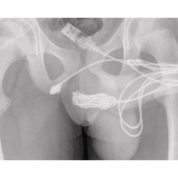 Ímãs, isqueiros e colheres: banco de dados dos EUA revela os objetos mais inusitados já inseridos em órgãos sexuais femininos e masculinos 