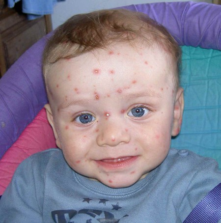 Chicken Pox