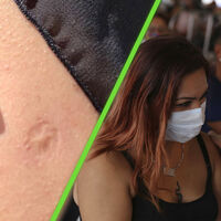 Por qué una vacuna dejó una marca en el brazo de todos los mexicanos
