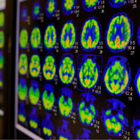 Esqueça as biópsias dolorosas porque a ciência acaba de revelar a tecnologia inesperada que funciona como uma lanterna contra o câncer