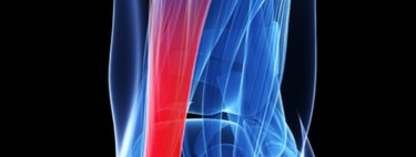 Tendinitis: Por qué este término está en desuso ( y cuál debes usar en su lugar)
