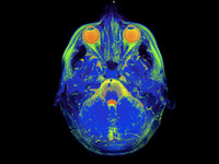 Los niños con problemas del comportamiento tienen un cerebro diferente 