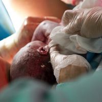 La cesárea antes del trabajo de parto altera la respuesta inmunológica del bebé