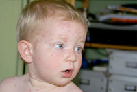 ¿Dónde está la vacuna de la varicela?