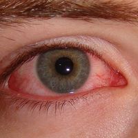 Así es como México se ha convertido en el tercer país del mundo en erradicar el tracoma