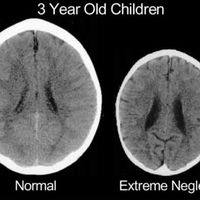 La terrible imagen que muestra lo que le pasa al cerebro de un bebé cuando nadie le atiende