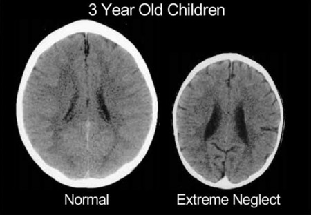 La terrible imagen que muestra lo que le pasa al cerebro de un bebé cuando nadie le atiende