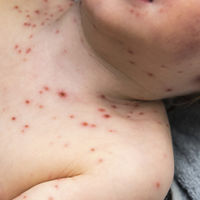 Un niño francés sin vacunar lleva el sarampión a Costa Rica, un país libre de la enfermedad desde hace cinco años