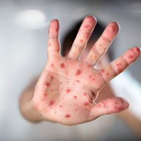 Alerta por sarampión en Europa: 69 muertes en los dos últimos años, las mismas que en los 17 anteriores