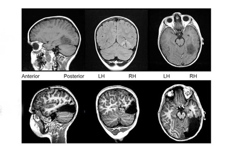 A pesar del trozo extirpado, el cerebro de este chico funciona correctamente