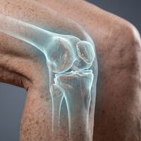 La artritis podría dejar de ser un problema, si este nuevo tratamiento para regenerar el cartílago de la rodilla llega a buen puerto 